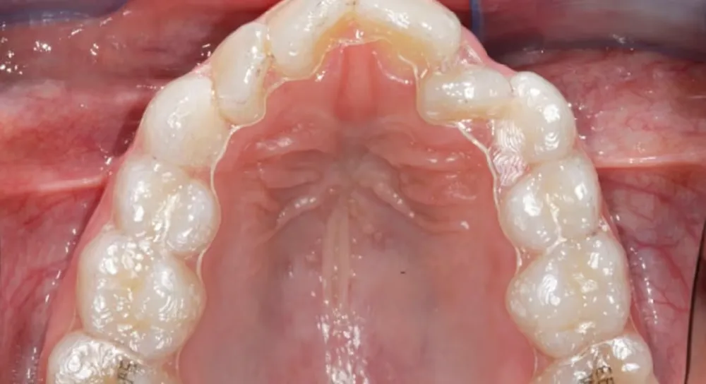Clear aligners — before