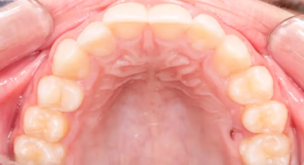 Clear aligners — after