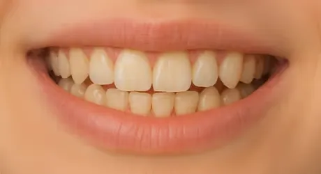 Braces — after