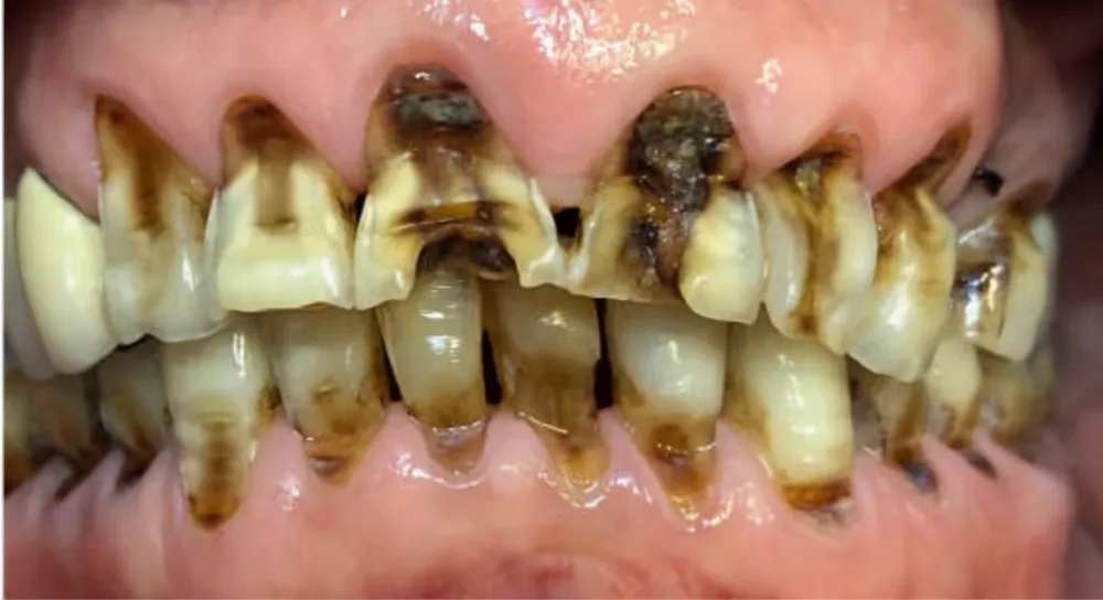 Full mouth rehabilitation — before