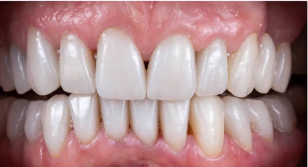 Full mouth rehabilitation — after